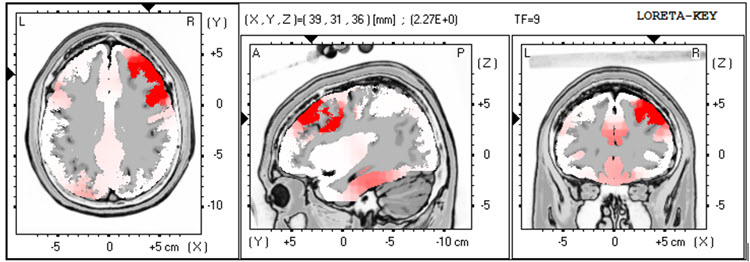 LORETA analysis at 9 Hz showing right lateral frontal excess